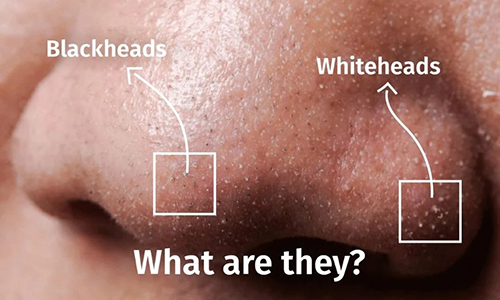 How to we get rid of blackheads and whitehead by Herbs